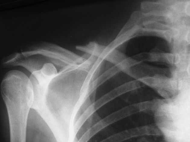 X-ray image of comminuted midshaft clavicular fracture