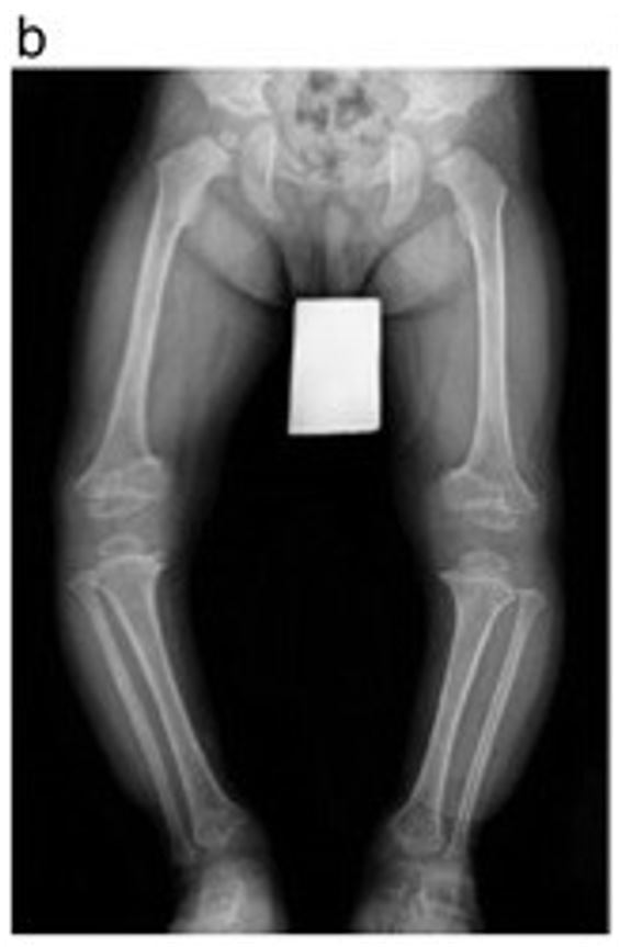 X-ray of a child with genu varum
