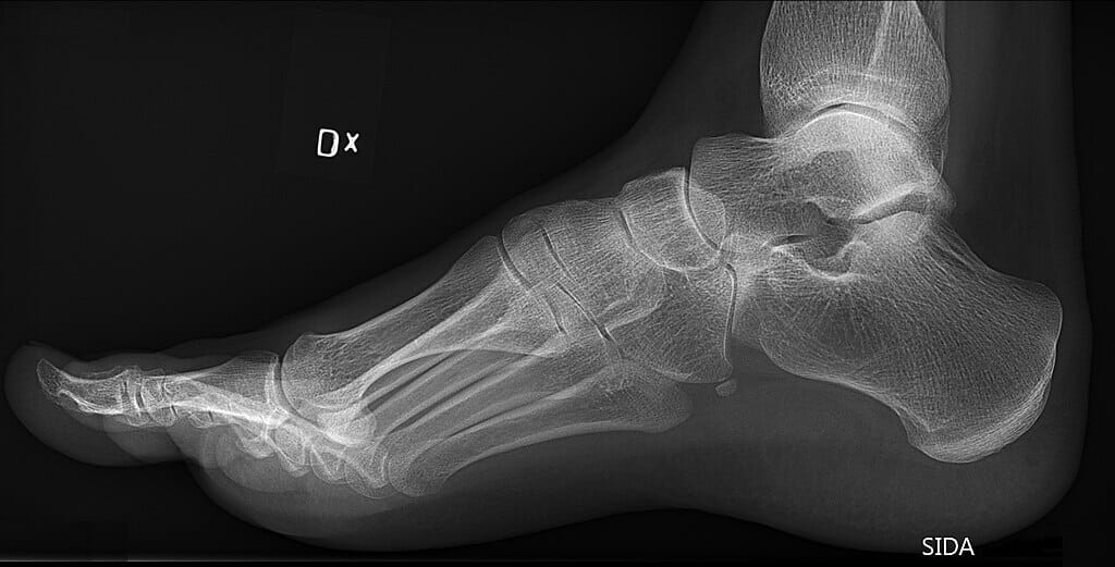 X-ray of a foot with pes cavus (high arch of the foot)