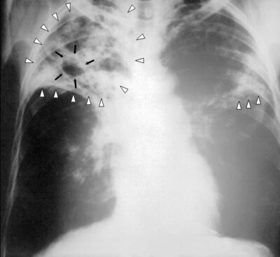 X-ray of advanced pulmonary tuberculosis