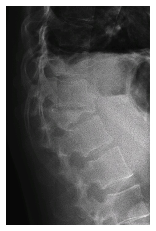 X-ray of burst fracture of t12