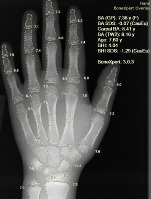 X-ray of hand for bone age estimation