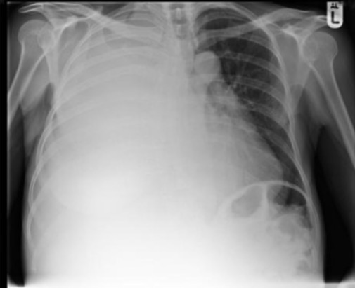 X-ray of patient's chest revealing a right-sided pleural effusion