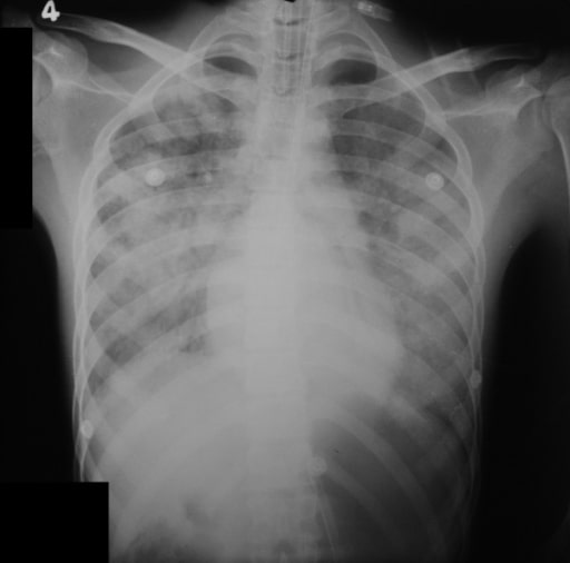 X-ray of severe leptospirosis