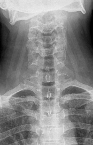 X-ray of the cervical spine of a 20 year old male - anteroposterior