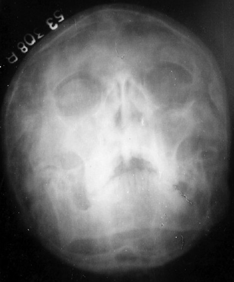 X-ray paranasal sinus