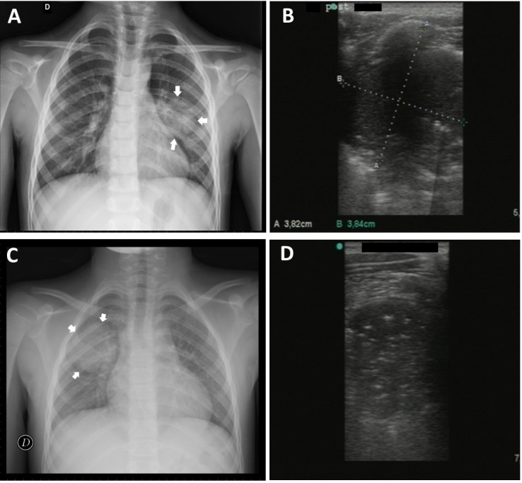 X-ray round pneumonia in infant