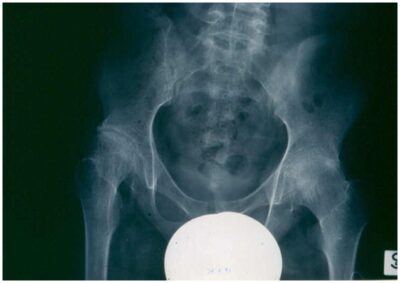 X-ray showing advanced destructive changes in the hips of a systemic jia patient