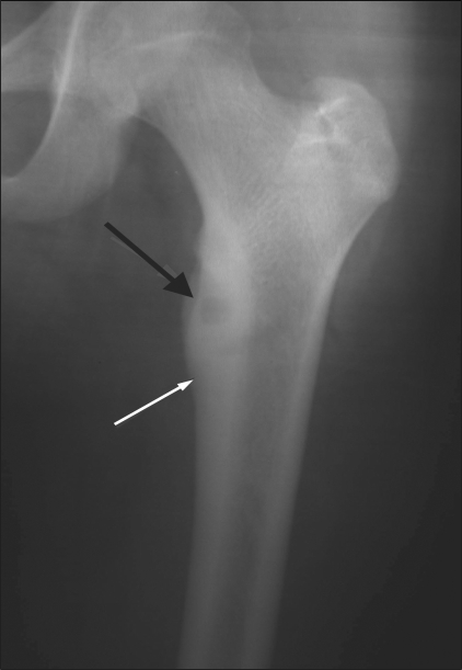 X-ray showing cortical osteoid osteoma involving the upper end of the femur