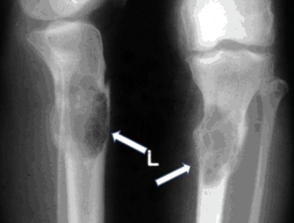 Raio-x de osteíte fibrosa quística do membro inferior esquerdo