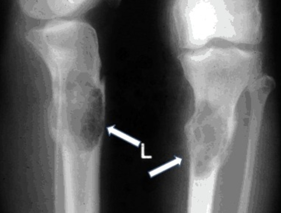 Рак кости ноги. Саркома большеберцовой кости рентген. Опухоли большеберцовой кости рентген. Саркома Юинга большеберцовой кости кт. Саркома Юинга плечевой кости рентген.