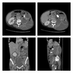 Pyelonephritis and Perinephric Abscess | Concise Medical Knowledge