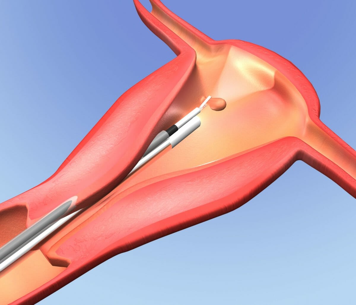 Schematic depiction of a forceps