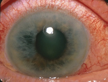 Acute angle glaucoma