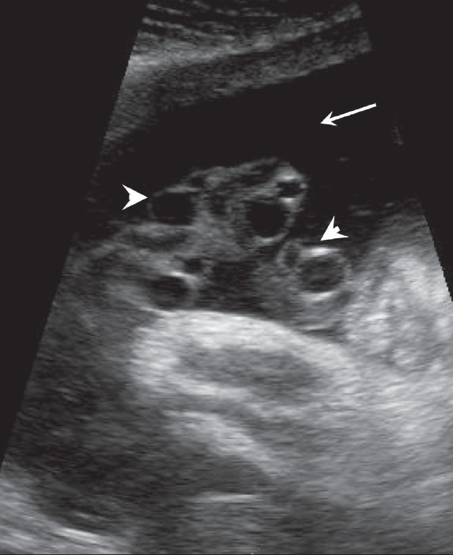 Ultrasound amniotic fluid pocket oligohydramnios