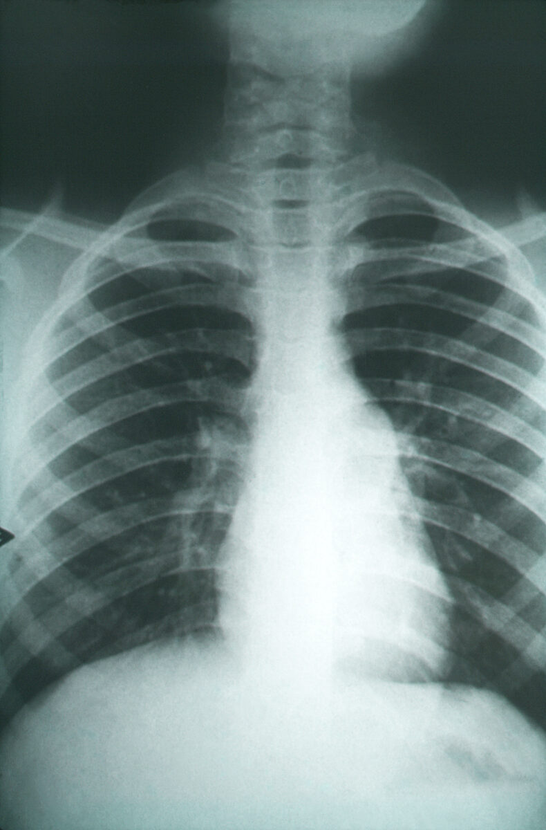 Radiografía de tórax anteroposterior con fibrosis pulmonar por coccidioidomicosis