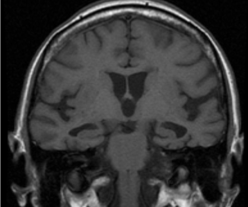 Bilateral hippocampal atrophy in alzheimer's disease