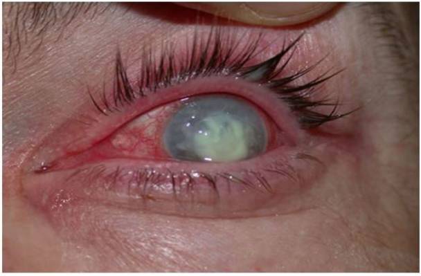 Case of corneal ulcer corneal abrasion