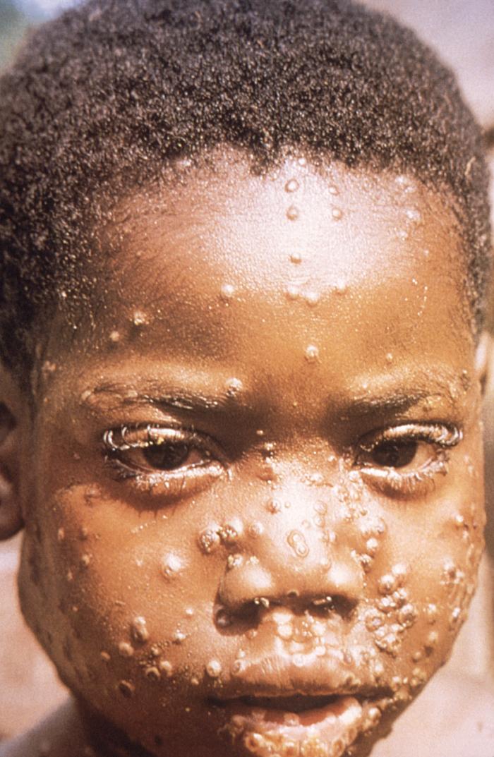 Young boy characteristic maculopapular monkeypox cutaneous rash smallpox orthopoxviridae