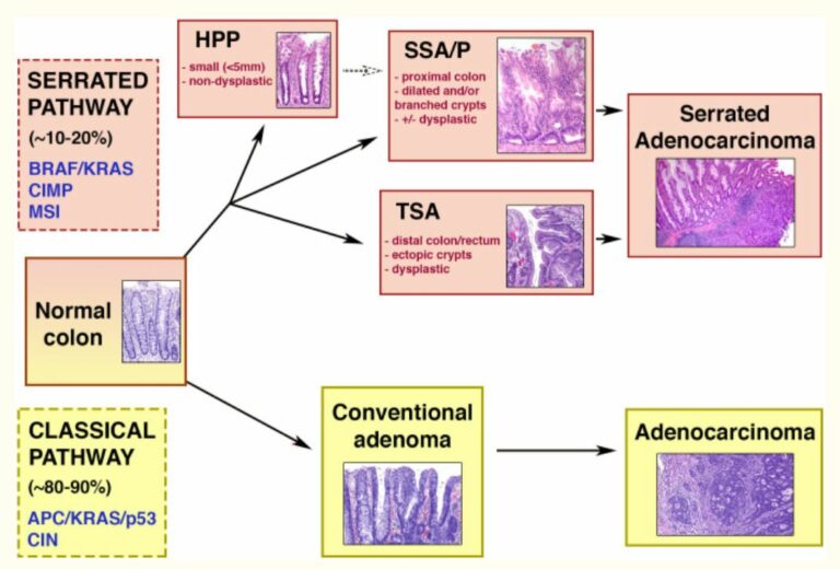 Colorectal Cancer Concise Medical Knowledge