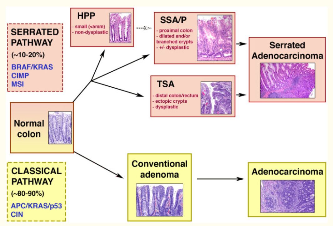 Classical adenoma-carcinoma and serrated pathways