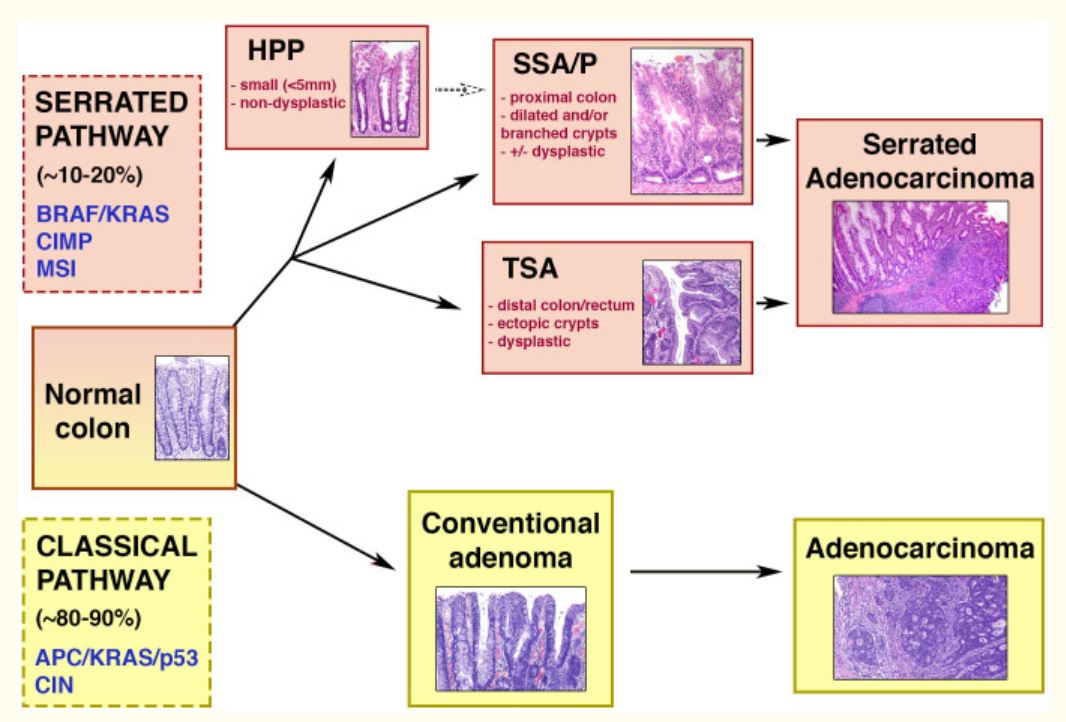 Pathophysiology Of Colon Cancer Schematic Diagram Adenoma Serrated ...