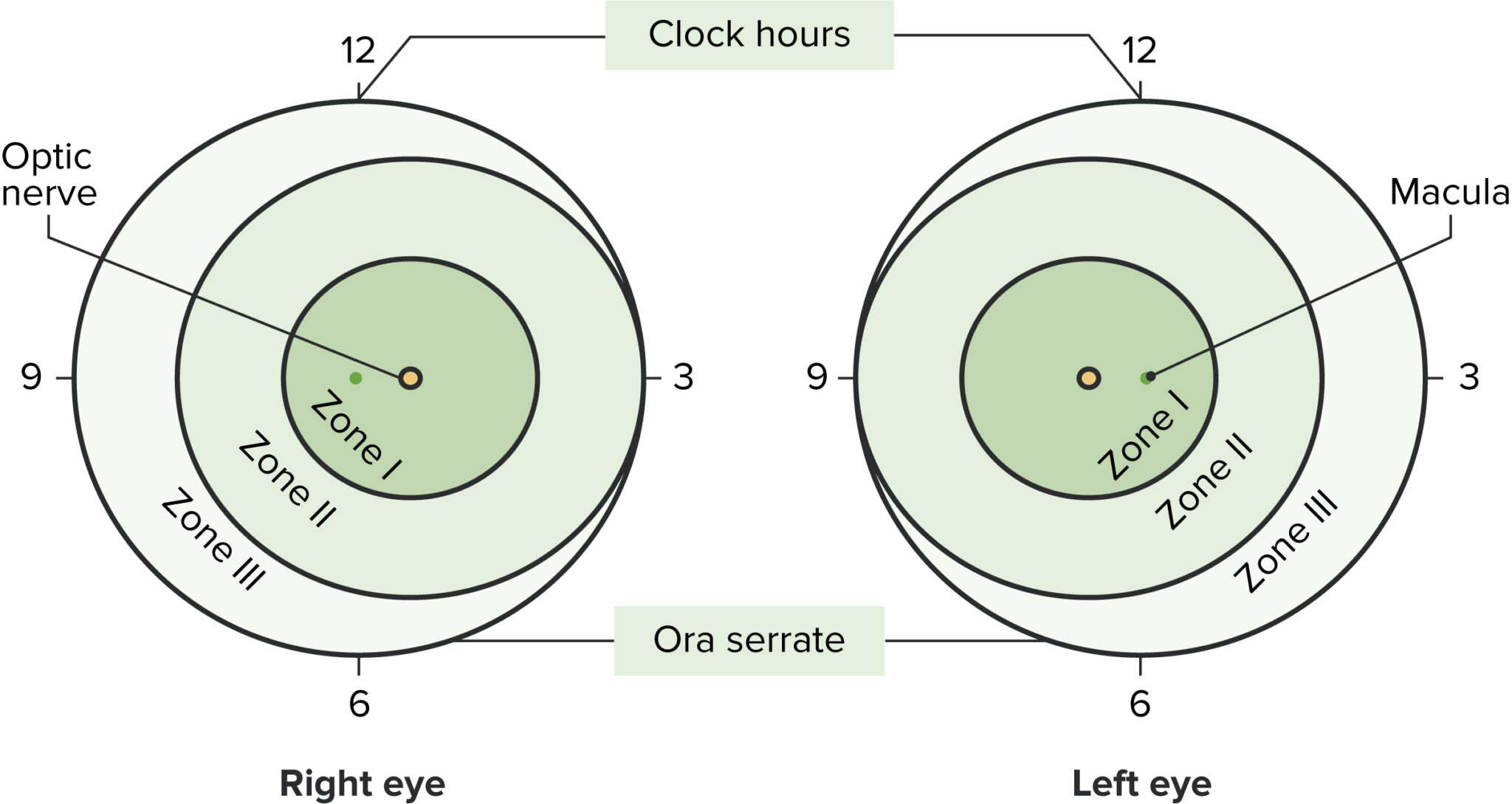 Retinopathy of Prematurity | Concise Medical Knowledge