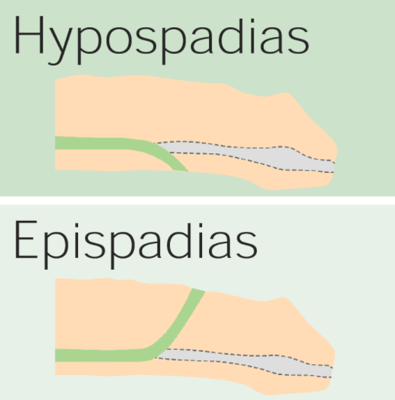 epispadias and hypospadias