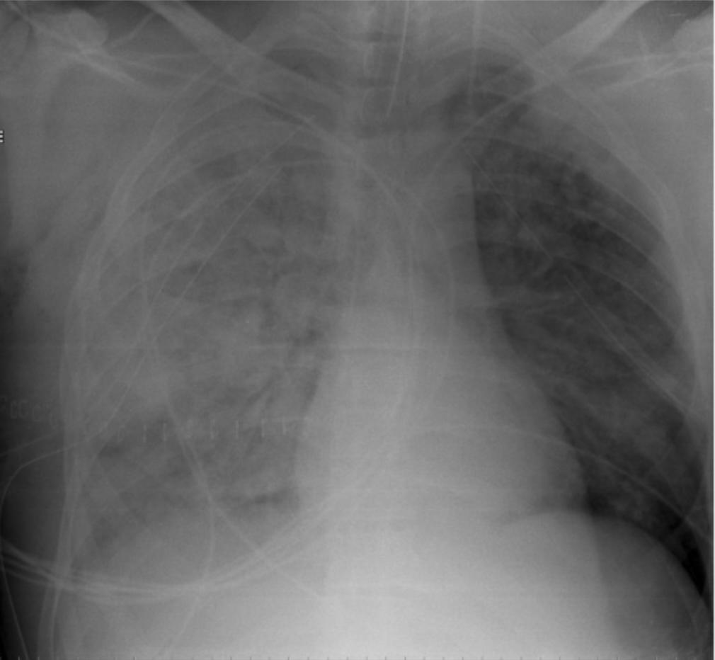 Diffuse bilateral lung infiltrates