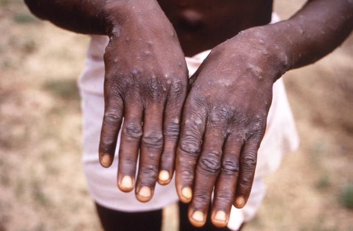 Dorsal surfaces of the hands monkeypox patient smallpox orthopoxviridae