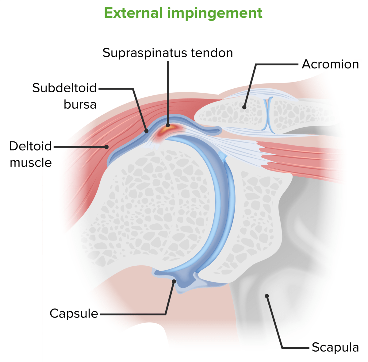 External shoulder impingement