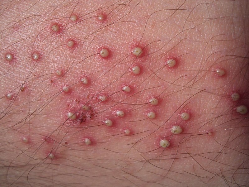 Folliculitis barbae - Altmeyers Encyclopedia - Department Dermatology