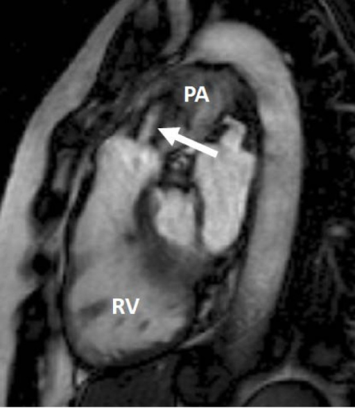 Fore-shortened right ventricle (rv) and a pulmonary valve with moderate-severe stenosis