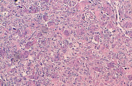 Giant cell tumor of bone