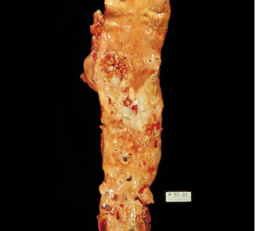 Gross pathology specimen of a human aorta