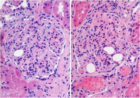 diffuse proliferative glomerulonephritis em