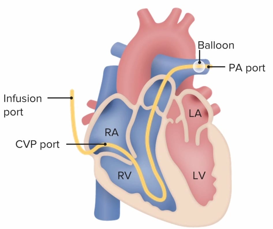 Graphic showing where to insert a Pulmonary Artery Catherer
