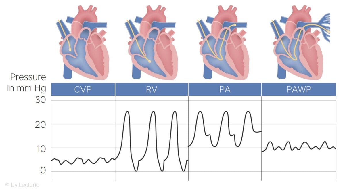 Monitor Paramaters of a Pulmonary Artery Catheter Guide