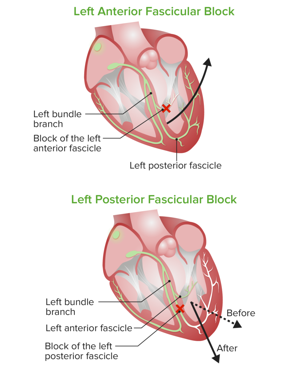 Bloqueos fasciculares anteriores y posteriores izquierdos