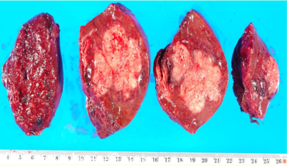 Liquefactive necrosis in liver
