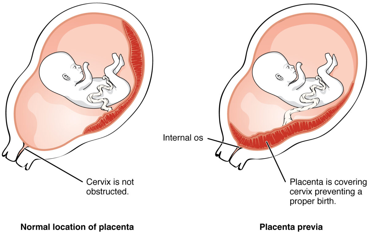 Location of the placenta in placenta previa