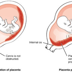 location of the placenta in placenta previa
