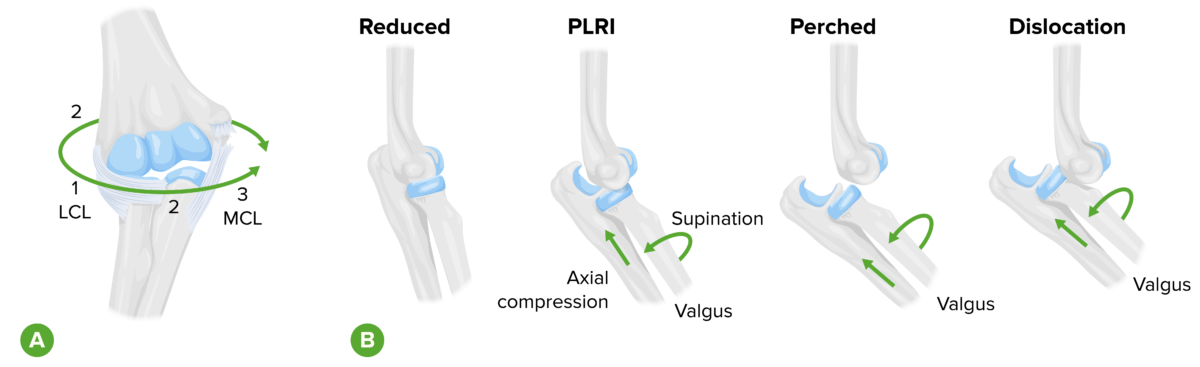 Mechanism of elbow dilocation diagram