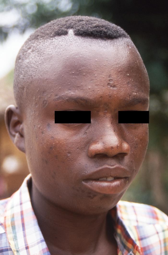 Permanent pox mark scars monkepox orthopoxviridae