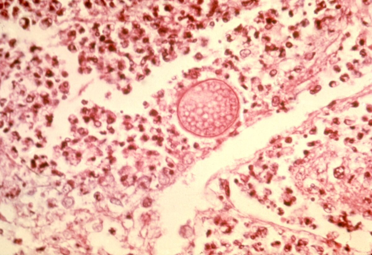 Photomicrograph of a lung tissue specimen pulmonary coccidioidomycosis