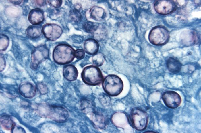 Photomicrograph of a methenamine silver stained tissue sample histoplasmosis