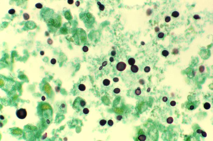 Photomicrograph of extracellular cryptococcus neoformans yeast