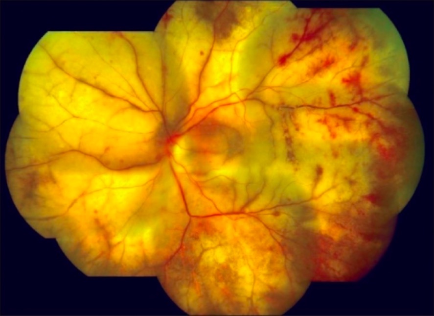 Progressive outer retinal necrosis
