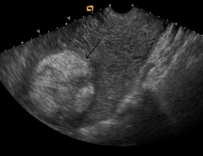 Transvaginal ultrasound demonstrates a heterogenous echogenic mass