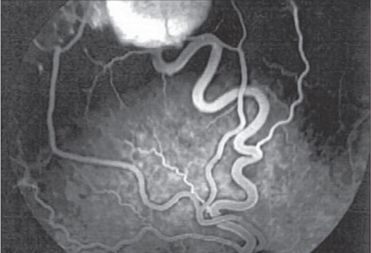Von hippel-lindau disease with exudative maculopathy